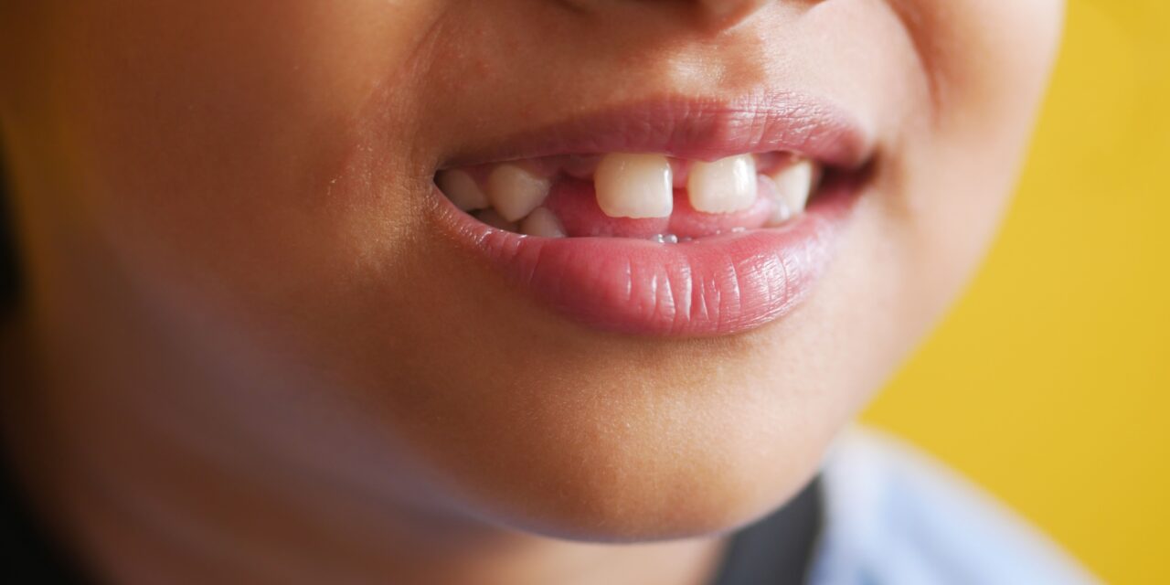 Manchas En Los Dientes De Bebés Y Niños, ¿Por Qué Aparecen?