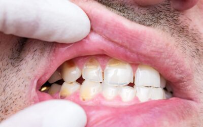 Hipoplasia dental; qué es, causas y tratamientos