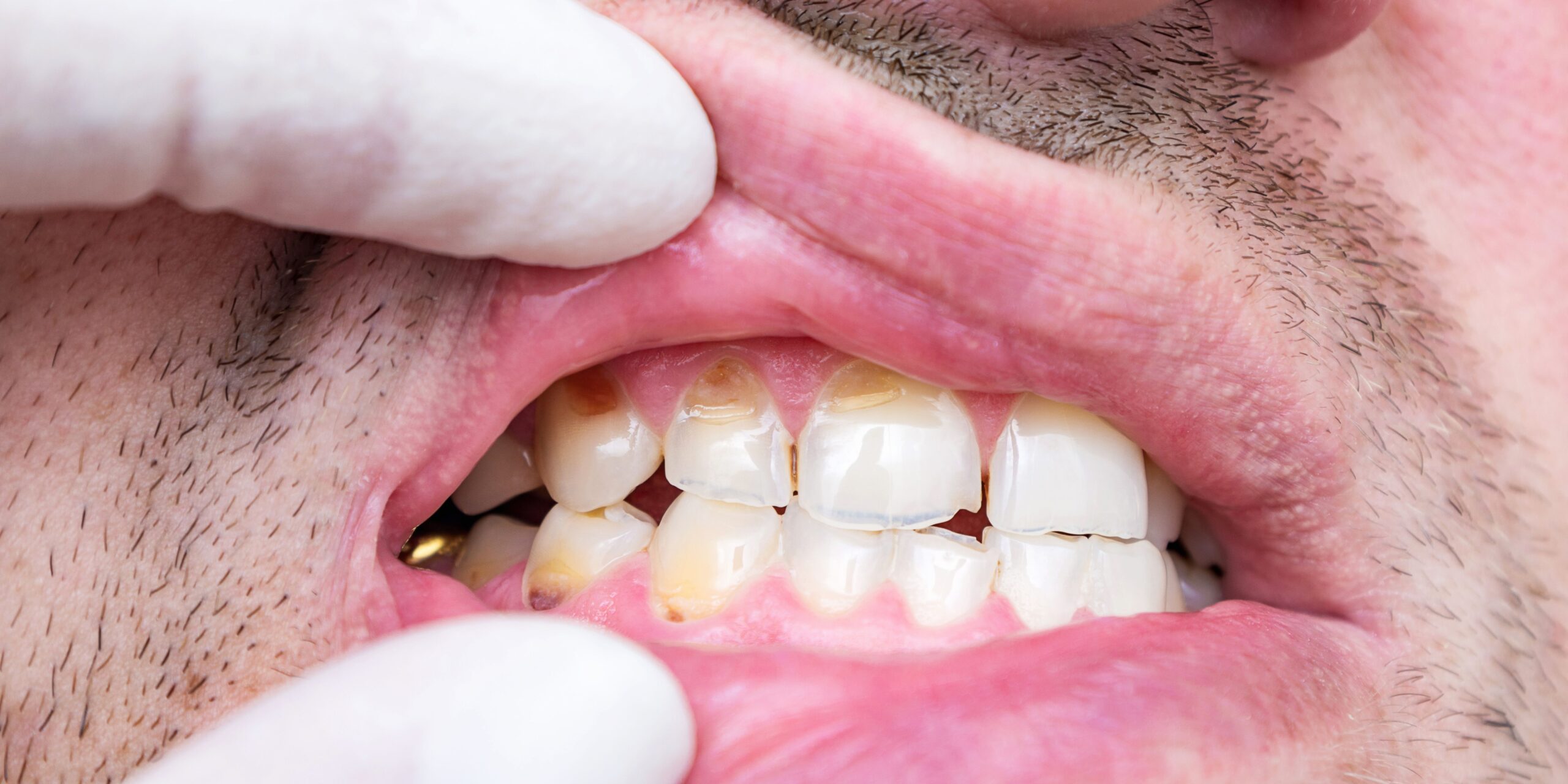 hipoplasia dental